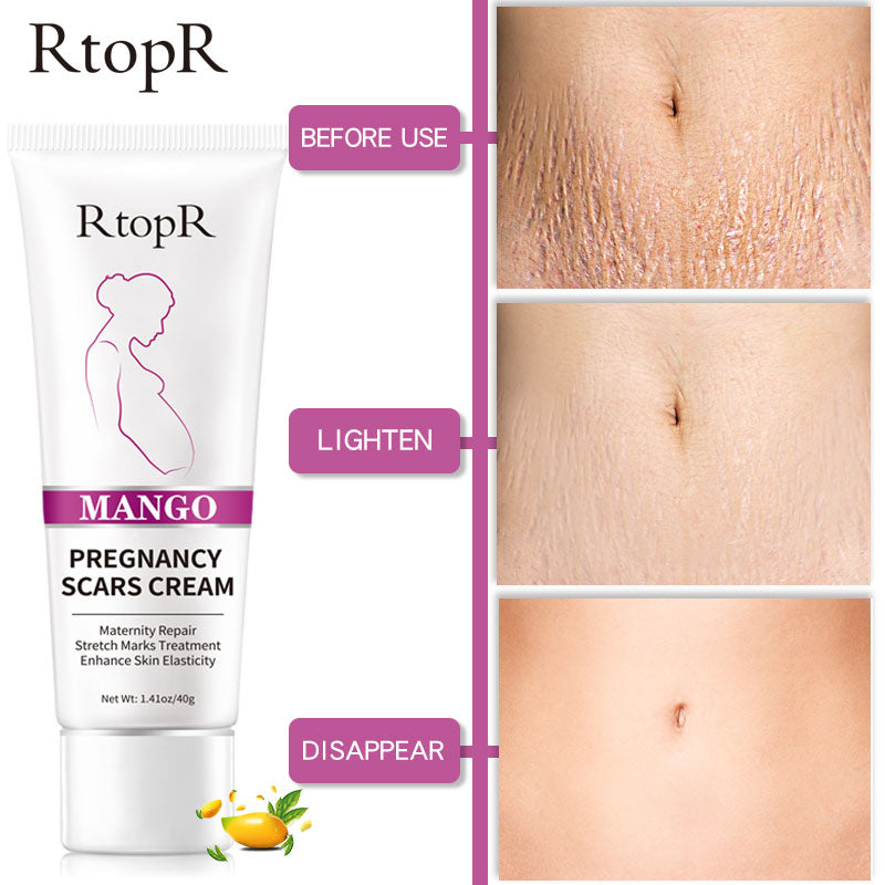 RtopR by Traci K Beauty Mango Remove Pregnancy Scars Acne Cream Stretch Marks Treatment Maternity Repair Anti-Aging Anti-Winkles Firming Body Creams