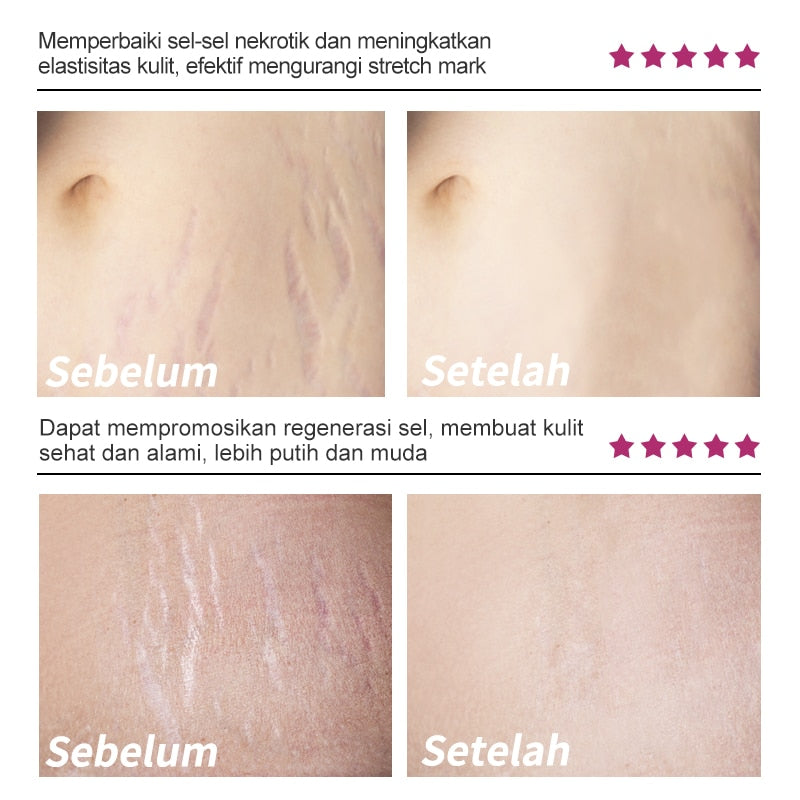 RtopR by Traci K Beauty Mango Remove Pregnancy Scars Acne Cream Stretch Marks Treatment Maternity Repair Anti-Aging Anti-Winkles Firming Body Creams